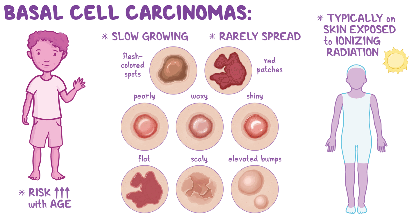 About Gorlin Syndrome