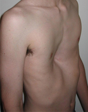 Lipomas Lump On Rib Cage Left Side Female, Pectus carinatum, also called a  protruding sternum or pigeon chest, is a rare deformity in children.